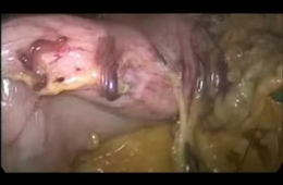 Laparoscopic removal of gastric band and gastric sleeve surgery | Op. Dr. Onur Peşluk